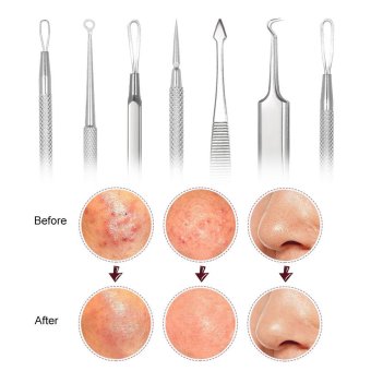 Abody 7pcs Blackhead Tool Acne Clip Facial Comedone Needle Set Facial Pimple Tweezer Stainless Steel Blemish Extractor - Intl Pebruari 2019 - 3 Abody 7pcs Blackhead Tool Acne Clip Facial Comedone Needle Set Facial Pimple Tweezer Stainless Steel Blemish Extractor - intl - 3