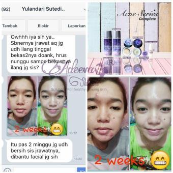 Adeeva Skincare Acne Complete Maret 2019 - 5 Adeeva Skincare Acne Complete - 5