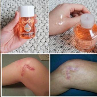 Bio Oil Original 100% Purecellin Oil Penghilang Bekas JerawatStretch Mark Bekas Luka Untuk Ibu Hamil Juni 2019 - 5 Bio Oil Original 100% Purecellin Oil Penghilang Bekas JerawatStretch Mark Bekas Luka untuk Ibu Hamil - 5