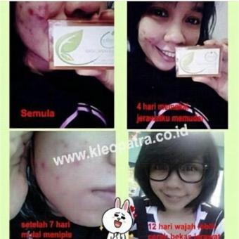 Sabun Pemutih Wajah Penghilang Flek, Jerawat Dan Bopeng Herbal Ampuh November 2018 - 3 Sabun Pemutih Wajah Penghilang Flek, Jerawat dan Bopeng Herbal Ampuh - 3